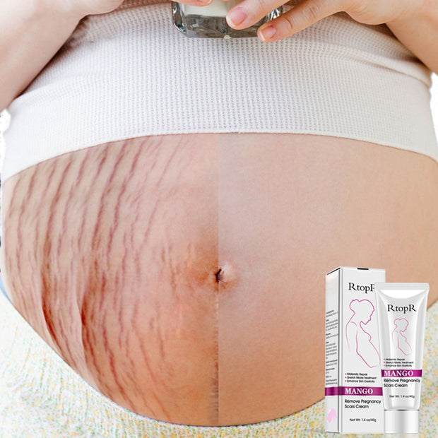 Mango Stretch Mark Cream For Pregnancy Repair